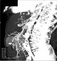 Abdominal Aortic Aneurysm (AAA) With Extensive Thrombosis - CTisus CT Scan