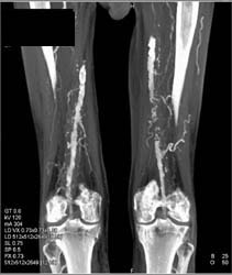 Occlusion Left Superficial Femoral Artery (SFA) - CTisus CT Scan