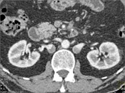 Duplicated Inferior Vena Cava (IVC) - CTisus CT Scan