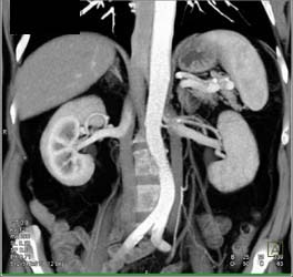 Duplicated Inferior Vena Cava (IVC) - CTisus CT Scan