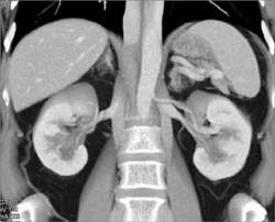 Duplicated Inferior Vena Cava (IVC) - CTisus CT Scan