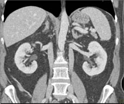 Duplicated Inferior Vena Cava (IVC) - CTisus CT Scan