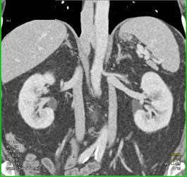 Duplicated Ivc - Vascular Case Studies - CTisus CT Scanning