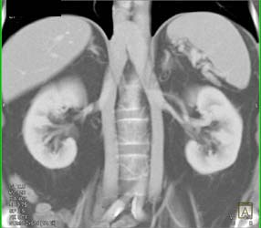 Duplicated Inferior Vena Cava (IVC) - CTisus CT Scan