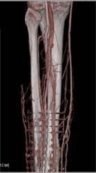 Vascular Injury - CTisus CT Scan