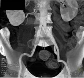 Abdominal Aortic Aneurysm (AAA) Repair - CTisus CT Scan