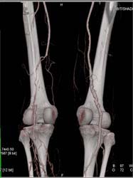 Occlusion of Right Superficial Femoral Artery (SFA) - CTisus CT Scan