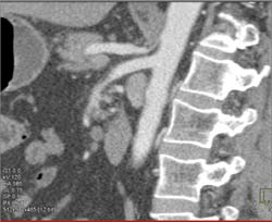 Median Arcuate Ligament Syndrome and Superior Mesenteric Artery (SMA) Stenosis - CTisus CT Scan