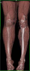 Soft Tissue Imaging - CTisus CT Scan