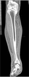 Patent Trifurcation and Edema - CTisus CT Scan