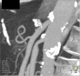 Plaque Near Celiac Origin - CTisus CT Scan