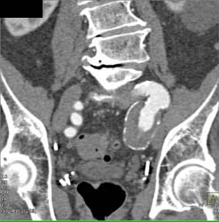 Iliac Artery Aneurysm - CTisus CT Scan