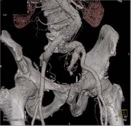 Iliac Artery Aneurysm - CTisus CT Scan