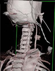 GSW to Carotid With Contrast Extravasation - CTisus CT Scan