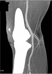 Normal Popliteal Artery - CTisus CT Scan