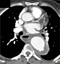 Aneurysm With Ulceration - CTisus CT Scan