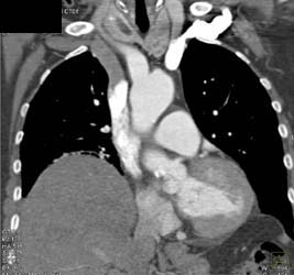 Left Sided Injection - CTisus CT Scan