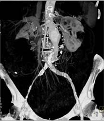 Abdominal Aortic Aneurysm (AAA) With Stents and Stenosis Right External Iliac Artery - CTisus CT Scan