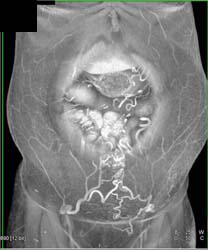 Varices - CTisus CT Scan