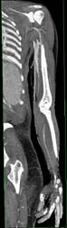 Av Fistulae With Multiple Renderings - CTisus CT Scan