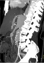 Aneurysm With Focal Dissection - CTisus CT Scan