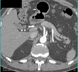 Hepatic and Splenic Arteries Arise Directly Off the Aorta - CTisus CT Scan