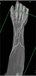 Nice CT Angio of the Forearm - CTisus CT Scan