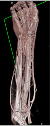 CTA of Hand With Range of Renderings and Lighting Modes - CTisus CT Scan