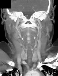 CTA of Neck With Nodule in Right Lobe of Thyroid Gland - CTisus CT Scan