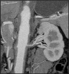 Takayasu's Arteritis Involves the Renal Artery and Abdominal Aorta - CTisus CT Scan