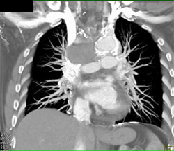 SVC Syndrome With Dilated Azygos Vein and Huge Collaterals - CTisus CT Scan