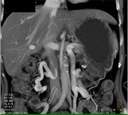 Large Left Gonadal Vein and Varices - CTisus CT Scan