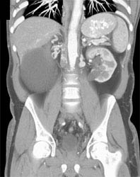 IVC Occlusion and Extensive Collaterals - CTisus CT Scan