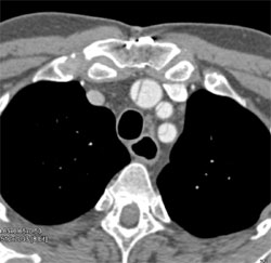 Aortic Dissection Extends Into Arch Vessels - CTisus CT Scan