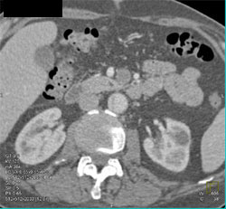 Aortic Dissection Invloves the Celiac Artery - CTisus CT Scan