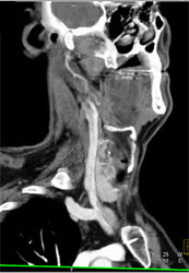 CTA of the Carotids - CTisus CT Scan