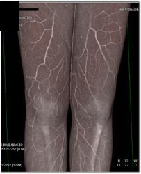 Multiple Renderings of the Thigh Vasculature With Various Lighting Modes - CTisus CT Scan