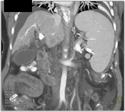 Clot in Portal and Splenic Vein - CTisus CT Scan