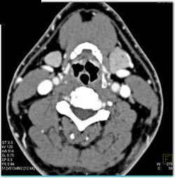 Normal Neck Vessels - CTisus CT Scan