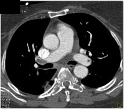 Massive Pulmonary Embolism - CTisus CT Scan