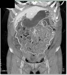 Splenic Vein Occlusion and Extensive Collaterals - CTisus CT Scan