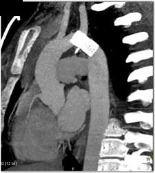 Stent Following Coarctation of the Aorta (COA) Repair - CTisus CT Scan