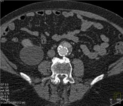 Endoleak - CTisus CT Scan