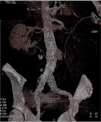 Endoleak - CTisus CT Scan