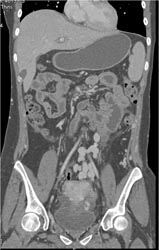 Huge Varices - CTisus CT Scan