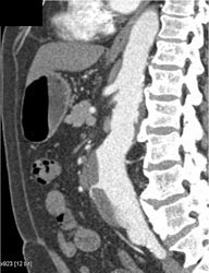 Abdominal Aortic Aneurysm (AAA) With Patent IMA - CTisus CT Scan