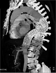 Stent in Descending Thoracic Aorta - CTisus CT Scan