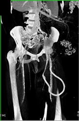 Av Fistulae - CTisus CT Scan