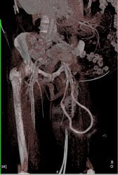 Av Fistulae - CTisus CT Scan