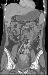 Pelvic Varices - CTisus CT Scan